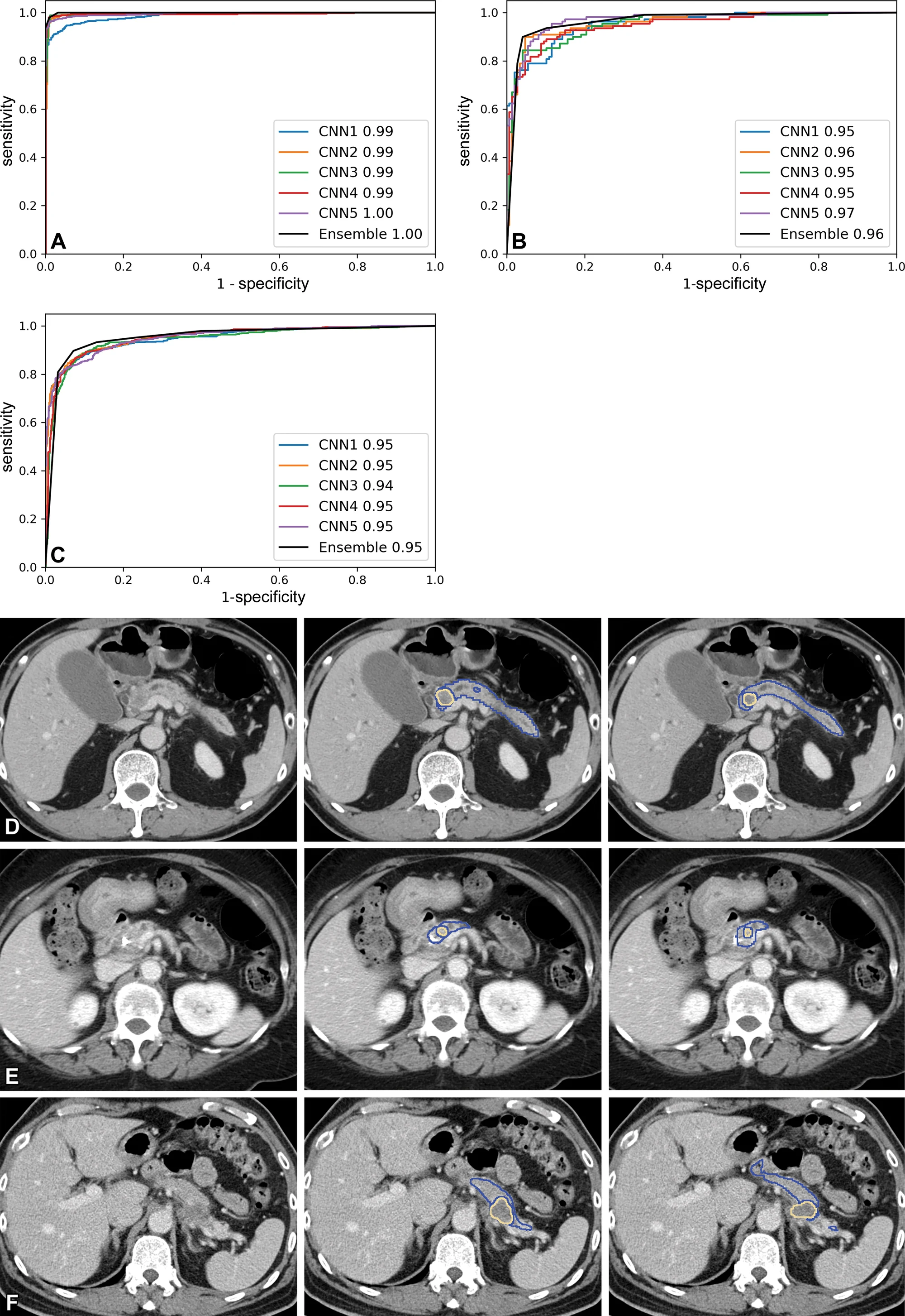 全國多中心驗證 ROC 曲線（AUC 0.95）— Radiology 220152 Figure 3