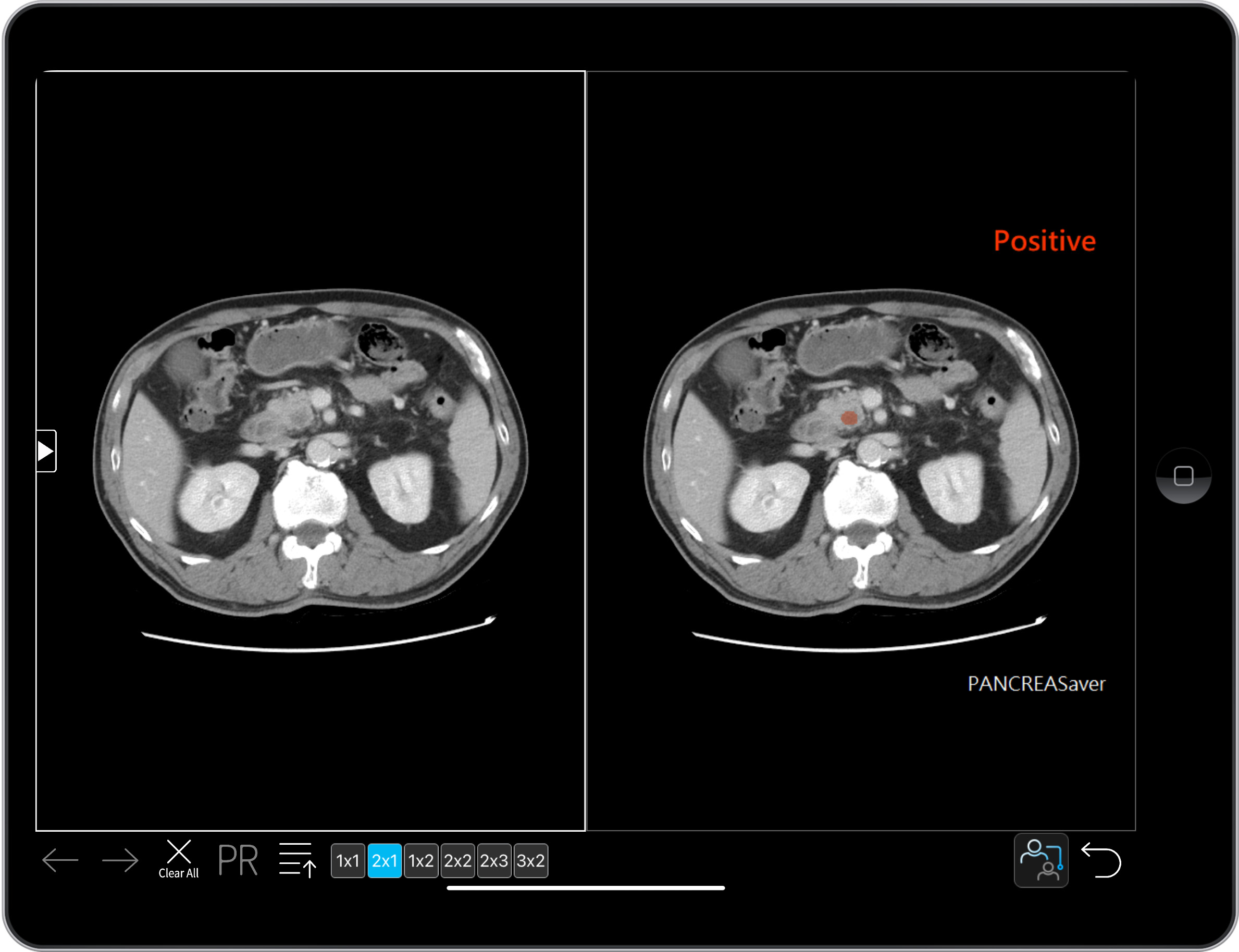 PANCREASaver system in clinical use