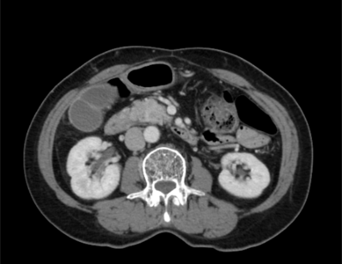 原始腹部CT影像